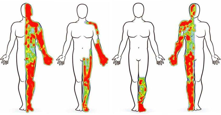 四张身体图用不同的绿色和红色区域表示疼痛