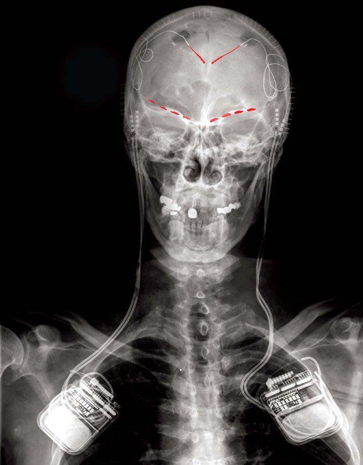 慢性疼痛的x光图在骨骼脑