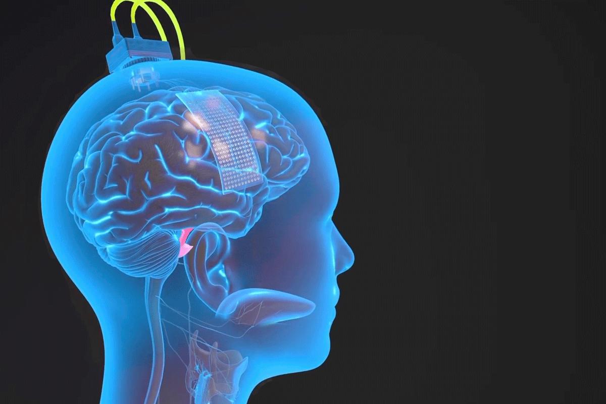 一个蓝色头部的插图，大脑可见，植入物在顶部